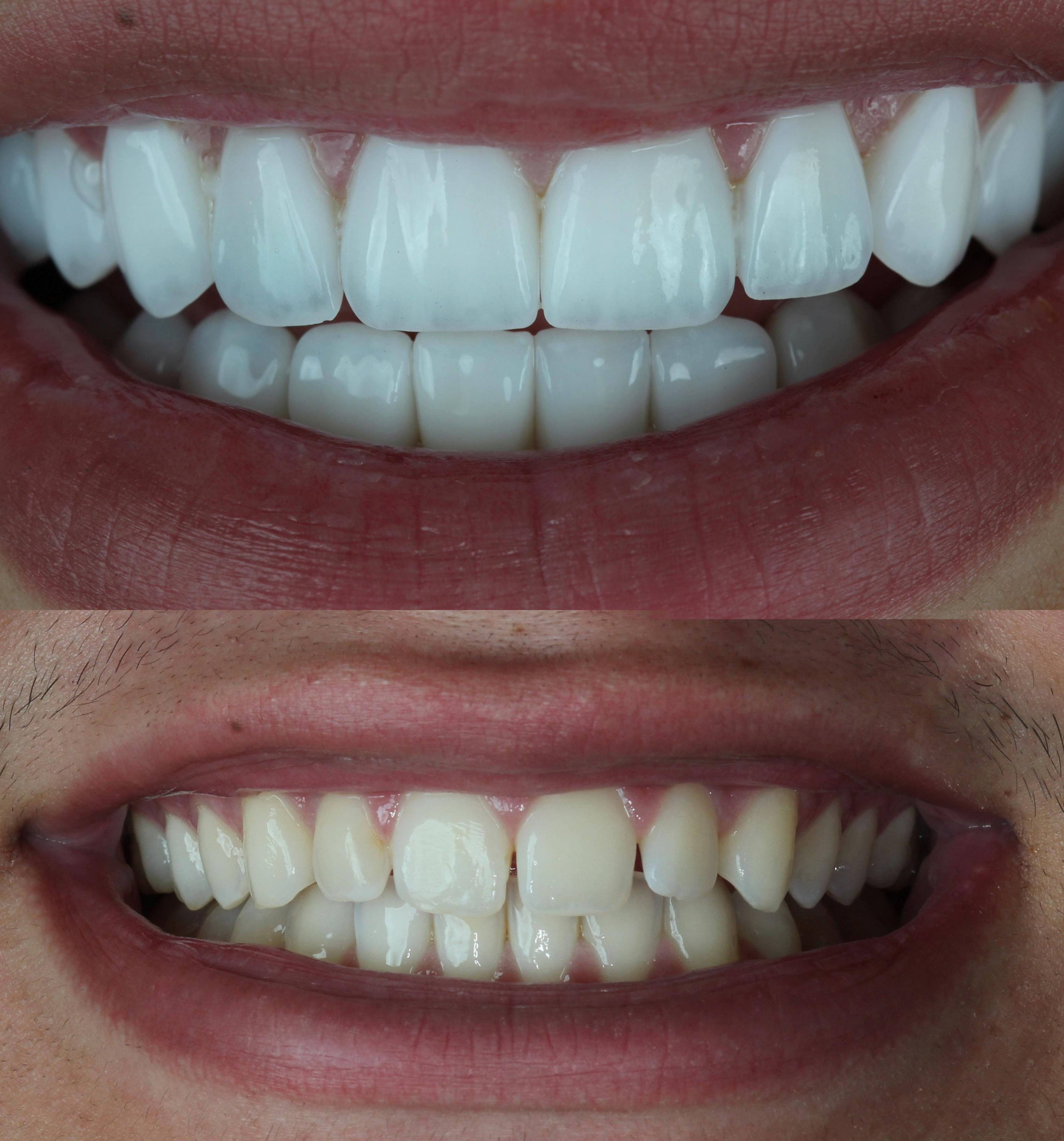 Paciente Antes e Depois